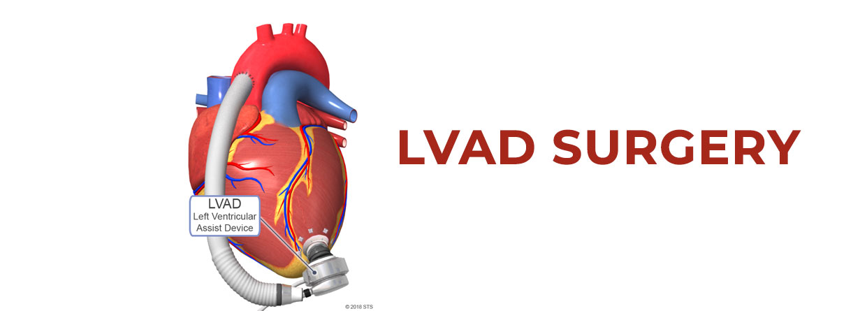 LVAD Surgery: Bridge to Transplant