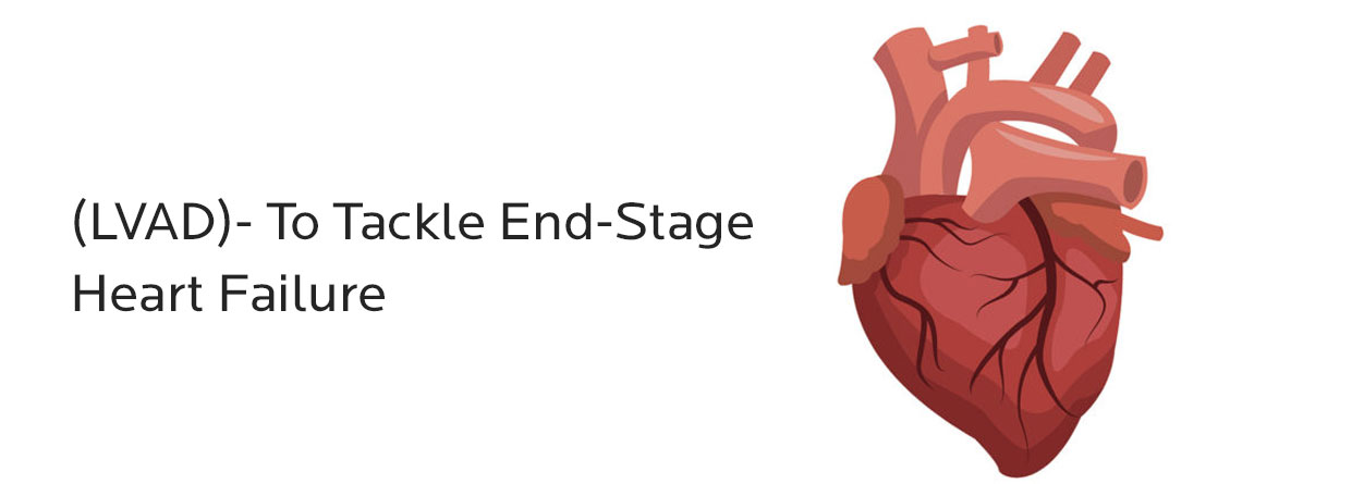 Left Ventricular Assisted Device (LVAD)- To Tackle End-Stage Heart Failure